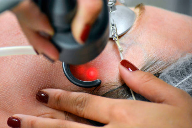 Acne Scar Removal in Riyadh
