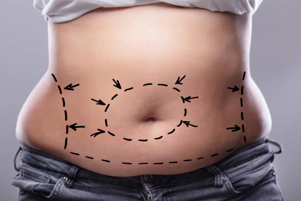 abdominoplasty in riyadh